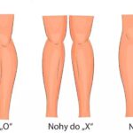 Jaký je rozdíl mezi valgózní a varózní deformitou nohy?